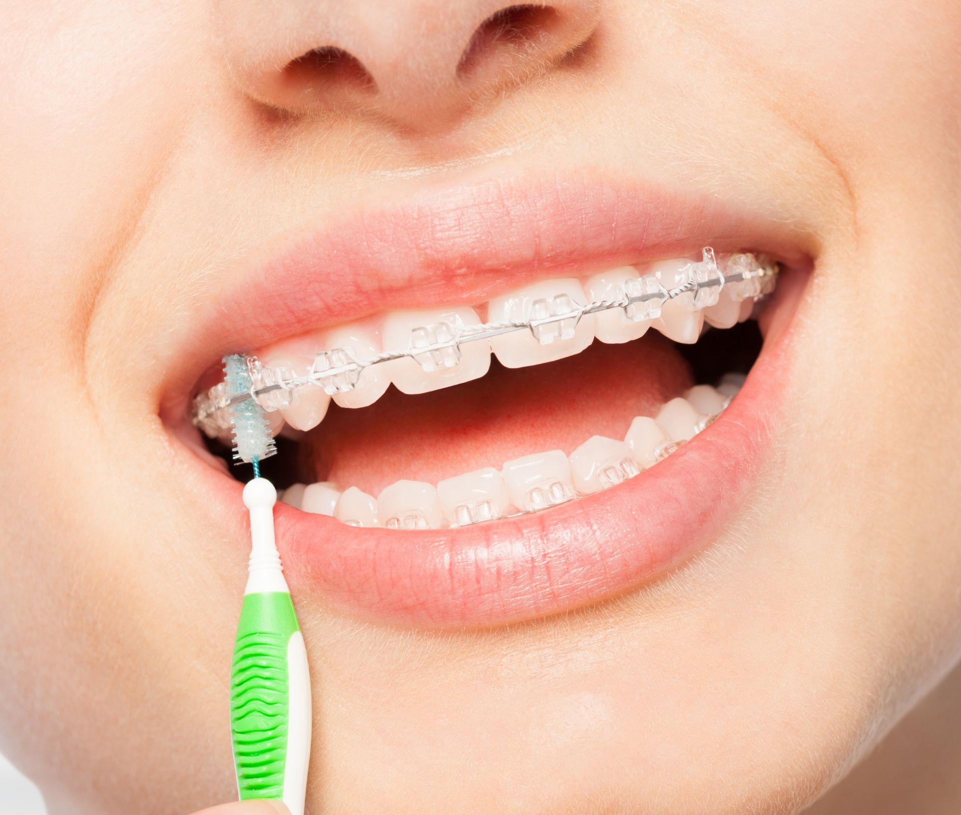 Ragazza utilizza scovolino suggerito da Dentista Ascoli Piceno per corretta manutenzione del suo apparecchio ortodontico